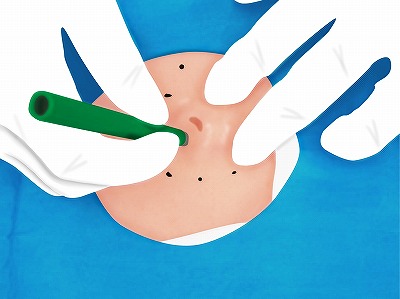 従来の治療方法 手順4