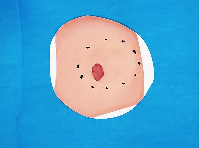 従来の治療方法 手順5