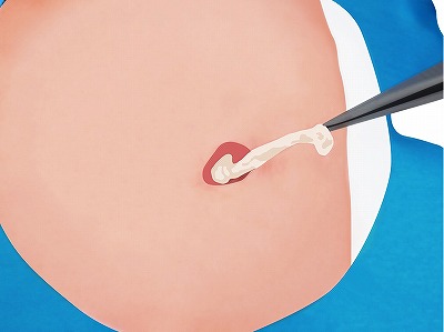 従来の治療方法 手順6