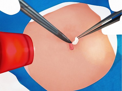 従来の治療方法 手順6