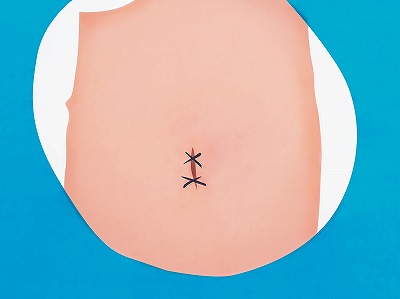 従来の治療方法 手順6