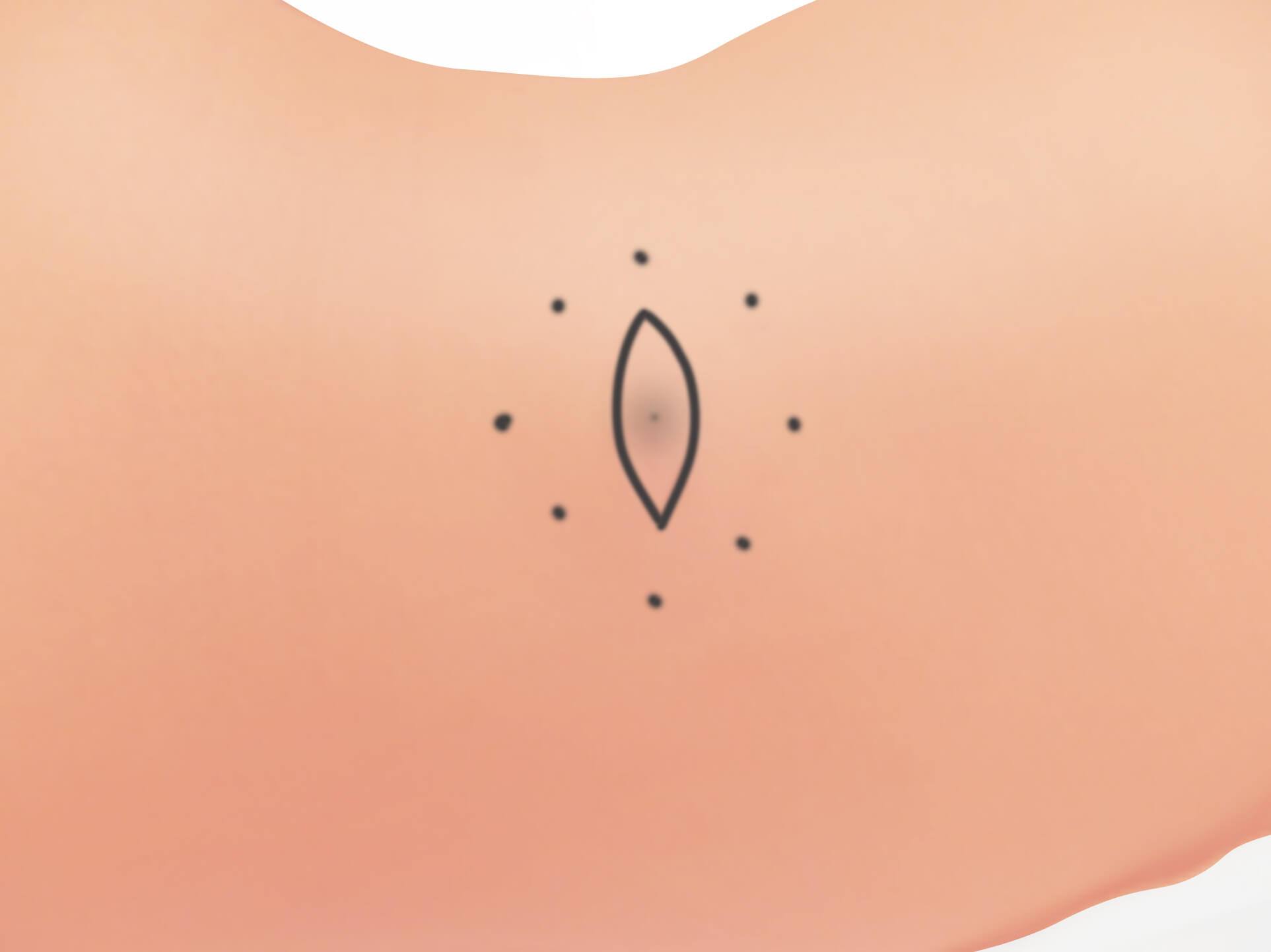 従来の治療方法 手順2