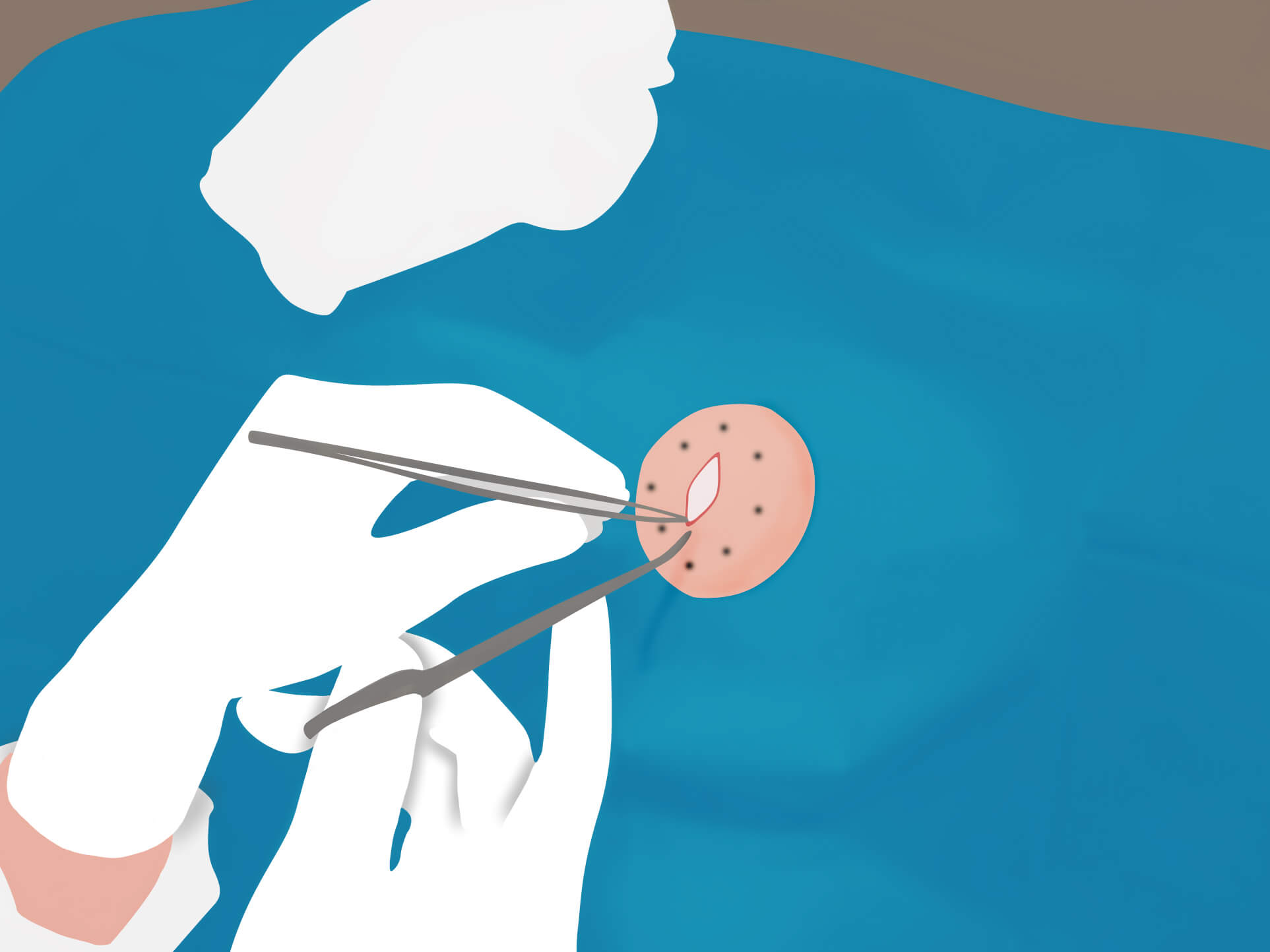 従来の治療方法 手順3