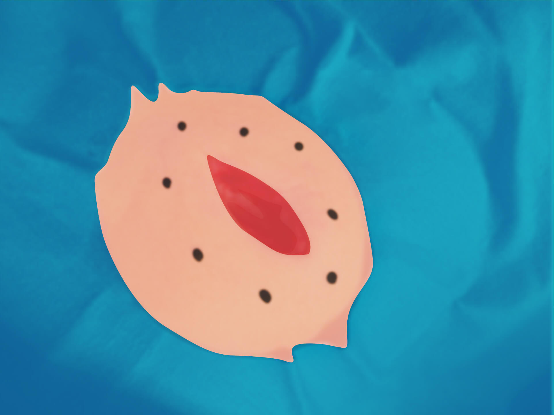 従来の治療方法 手順9