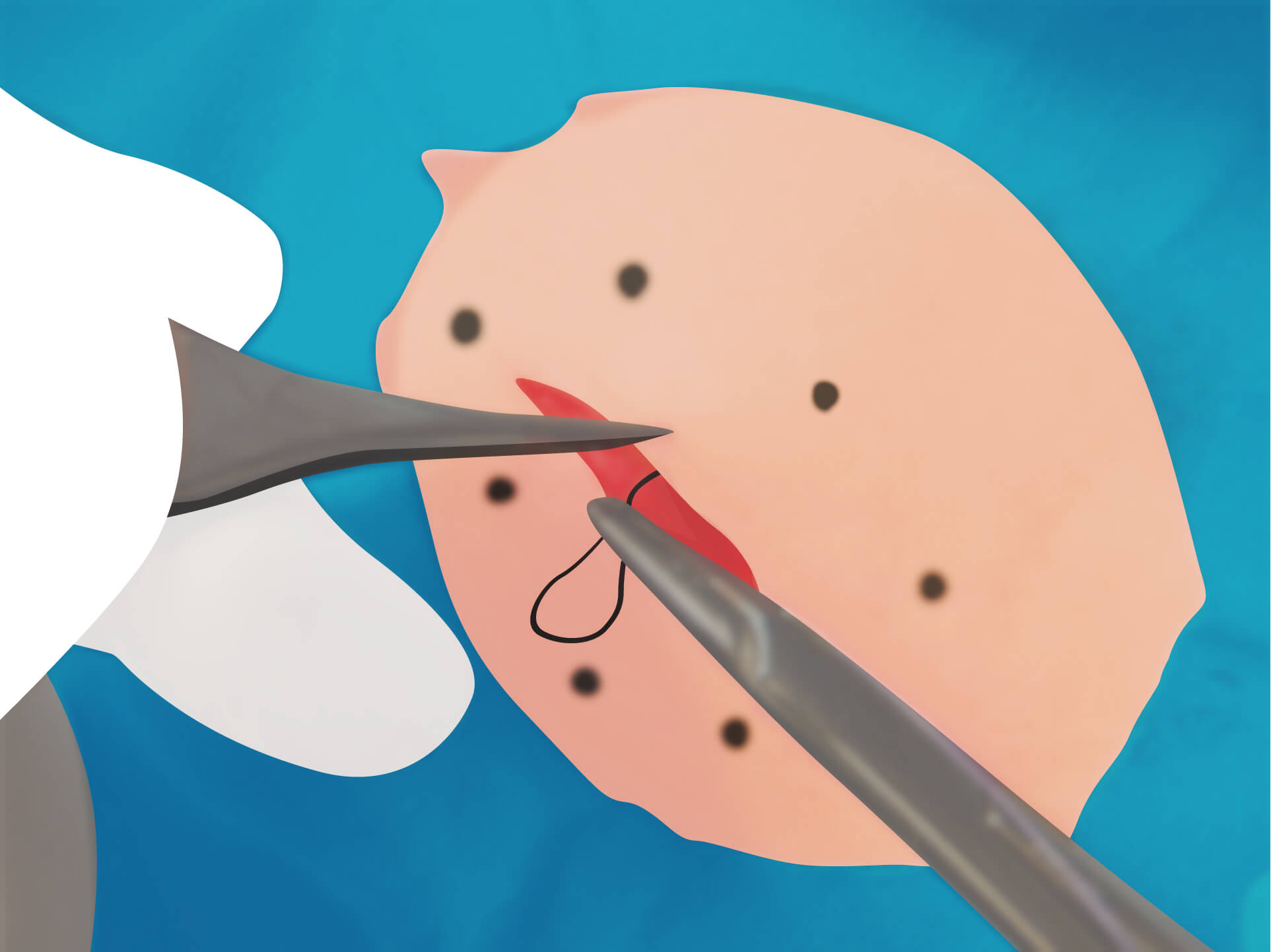 従来の治療方法 手順10