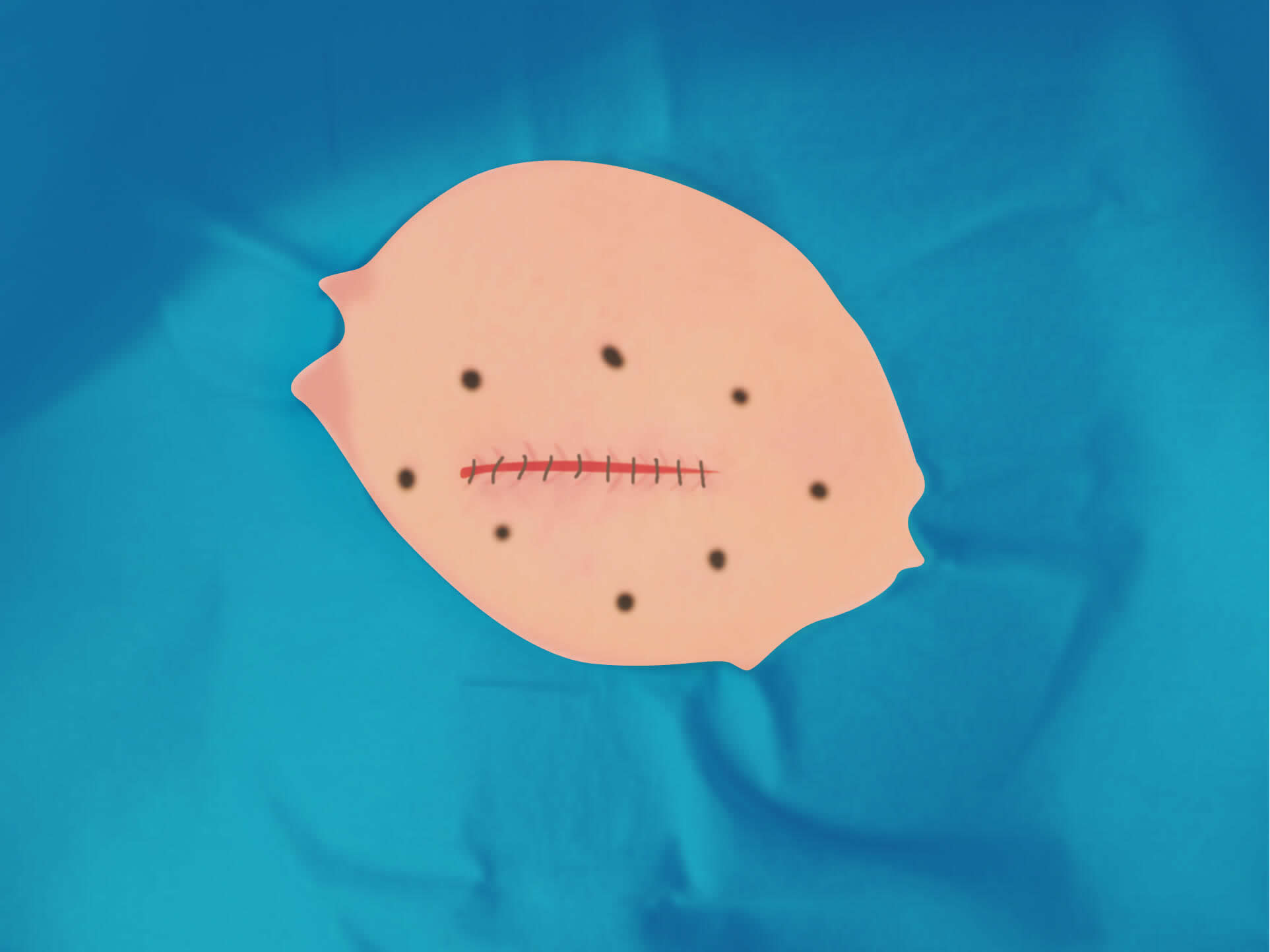 従来の治療方法 手順13