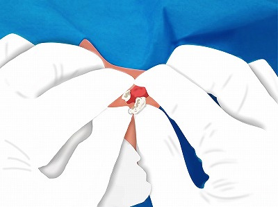 くり抜き法 手順6